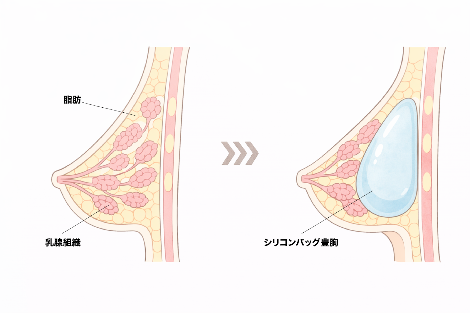 シリコンバッグ豊胸の施術イメージ図