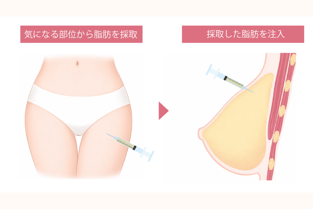 気になる部位から脂肪を採取し、バストに注入するイメージ